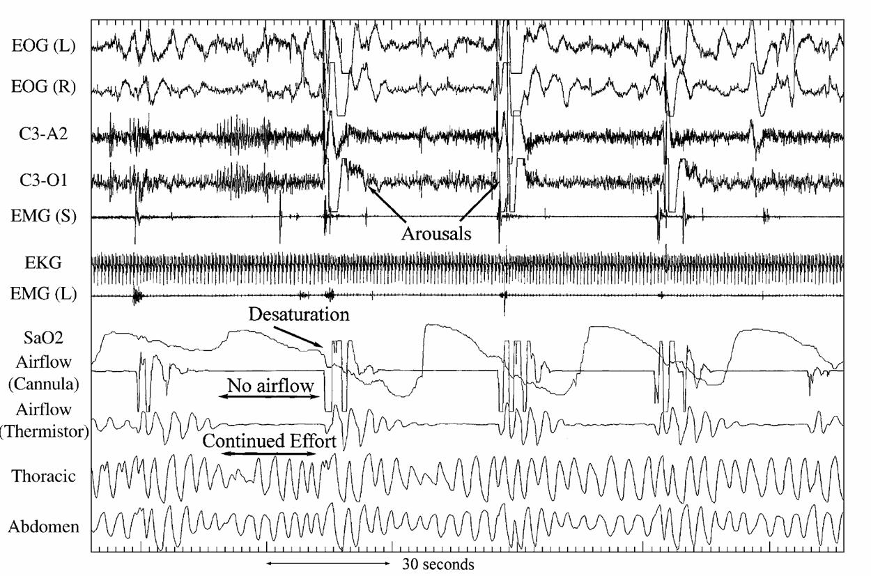 Polysomnography - Wikipedia